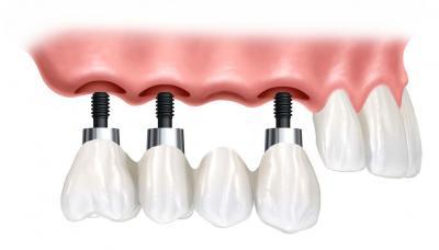 зъбен имплантат от aba-implant.bg зъбен имплантат от aba-implant.bg